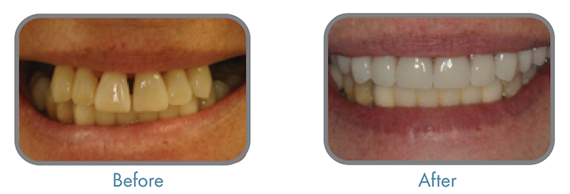 Vienna-VA-Veneers-Dentist